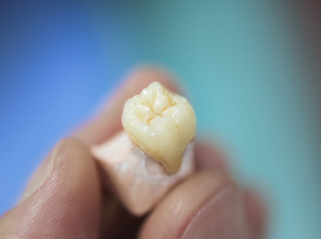 Dental Prosthesis